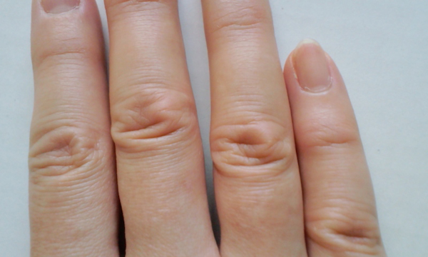 指 の 第 二 関節 腫れ