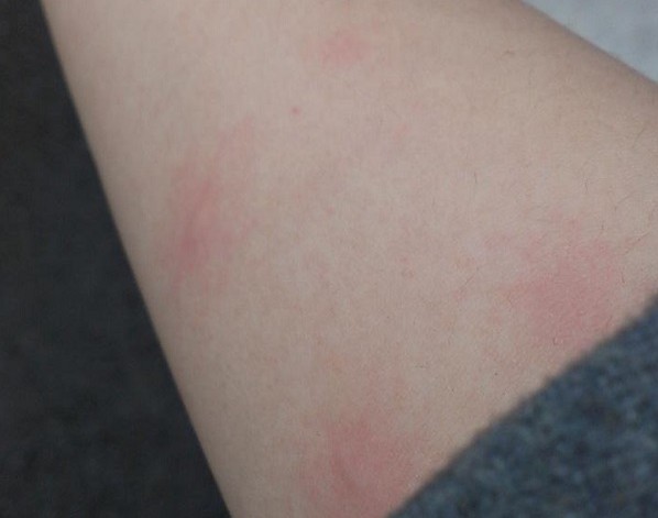 アルコールアレルギー湿疹を起こさないための５つの予防策